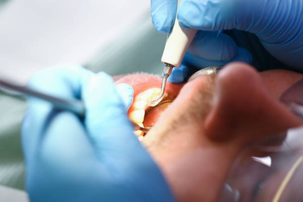 Best Dentist for Tooth Abscess  in Lone Tree, IA